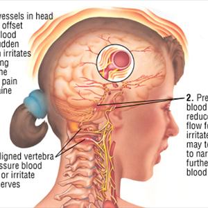  Migraines 
