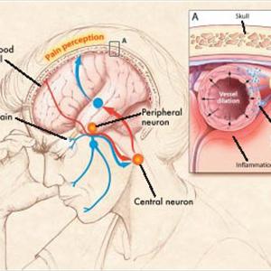 Migraine Headache Symptoms - What Is A Cluster Headache? What Is The Remedy?