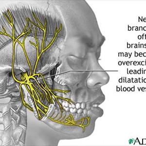 Migraine Headache Research - A Simple Migraine Headache Cure - Easy Tips That Anyone Can Use