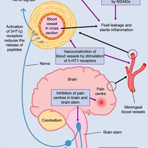 Severe Headache And Nausea - Cervicogenic Headache