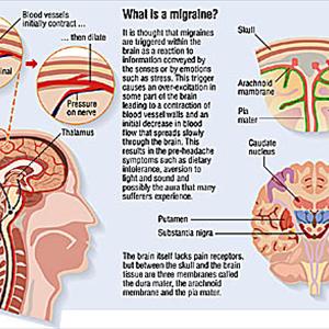 Migraine Equivalent Vertigo - Migraines Causes And Cures