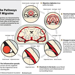 Migraine Equivalent Questions 