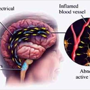 Migraine Diet Recipes - Stop Or Reduce Migraine Headaches With Butterbur Extract